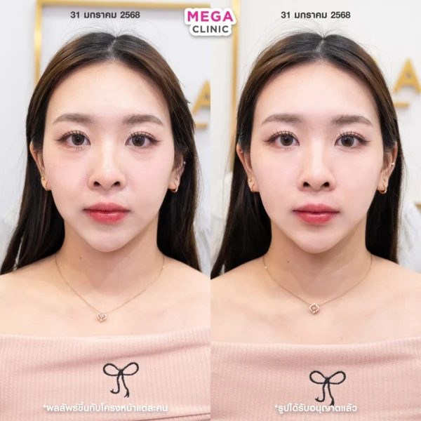 眼底填充剂评论