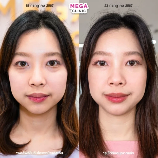 眼底填充剂评论