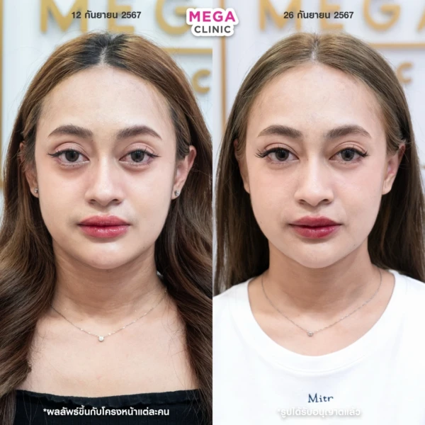 眼底填充剂评论