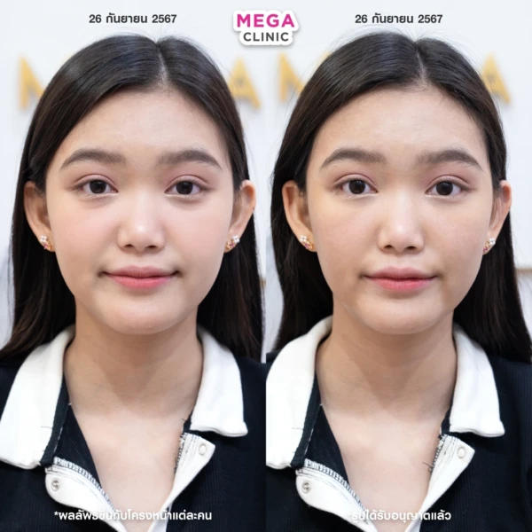 眼底填充剂评论