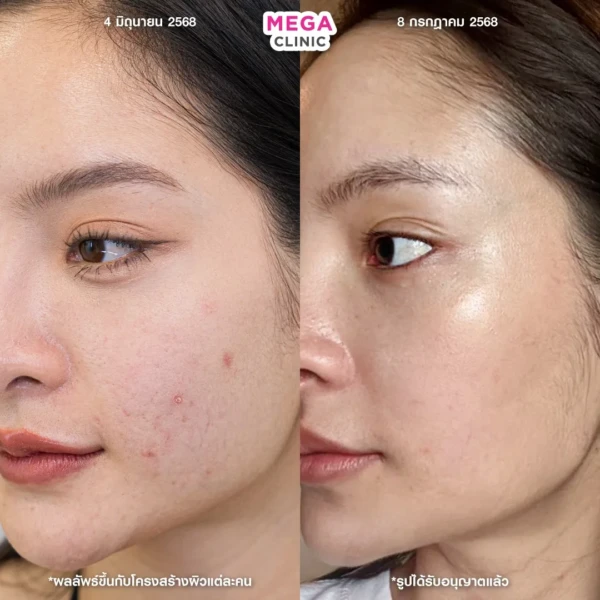 รีวิว Rejuran