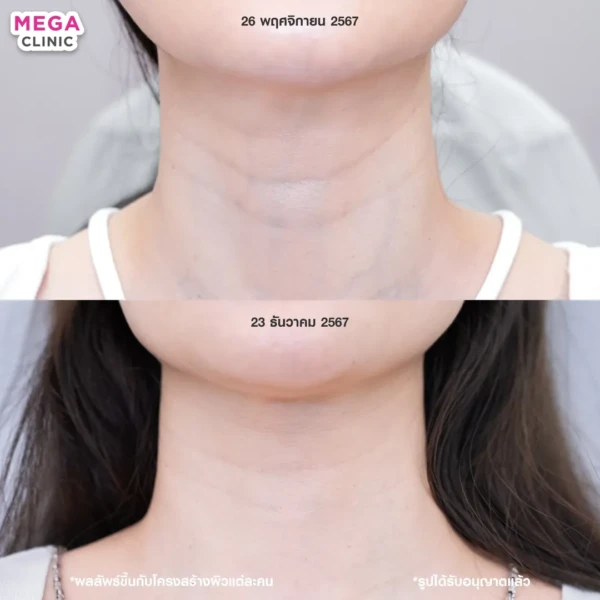 รีวิว juvelook