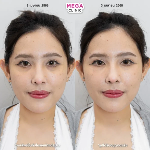 รีวิว juvelook