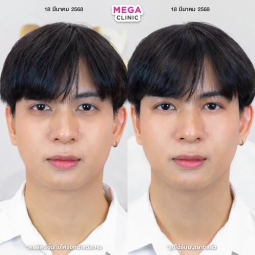 รีวิว juvelook