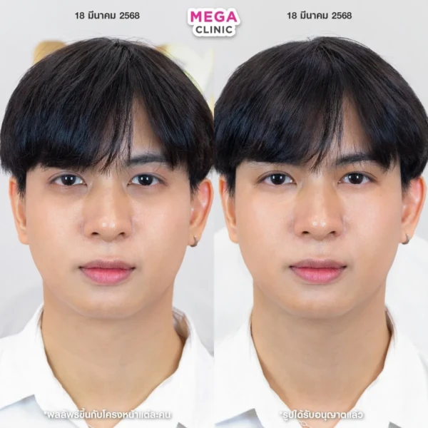 รีวิว juvelook