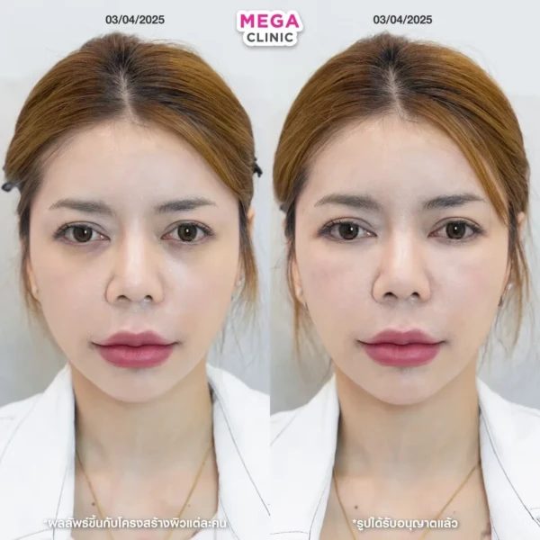 รีวิว juvelook