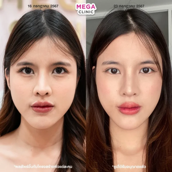 รีวิว juvelook