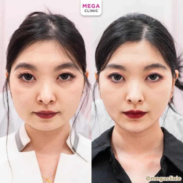 Chin filler reviews: