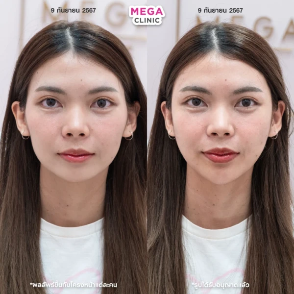 รีวิว ฟิลเลอร์คาง