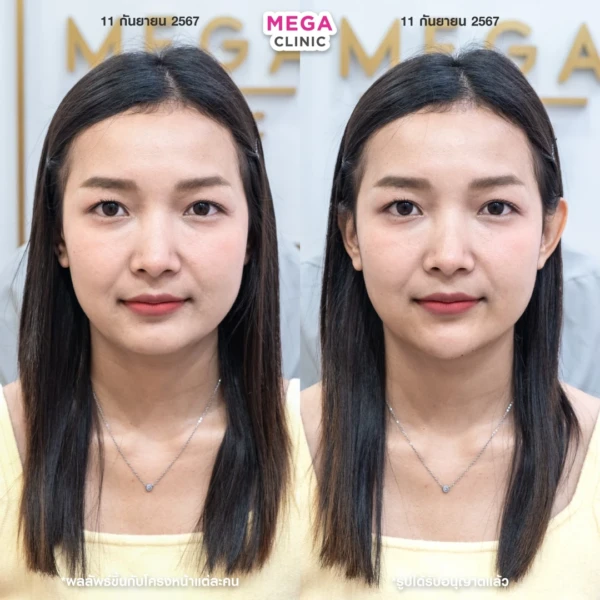 Chin filler reviews: