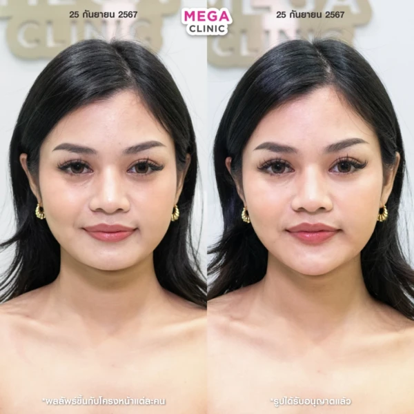 รีวิว ฟิลเลอร์คาง