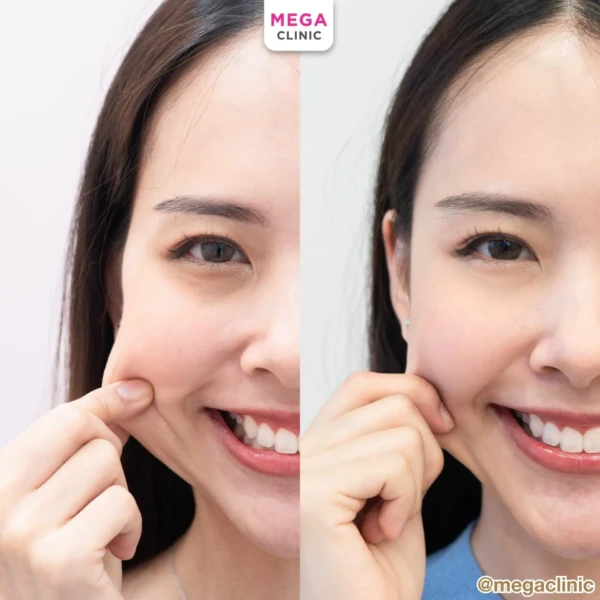 ฉีด sculptra รีวิว