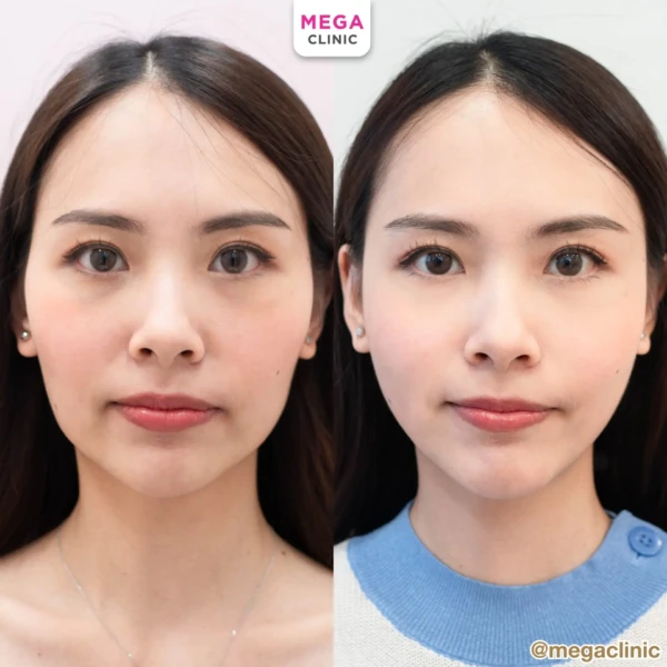 ฉีด sculptra รีวิว