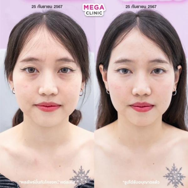 眼底填充剂评论