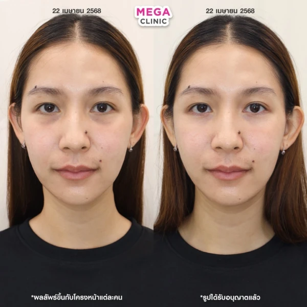 眼底填充剂评论