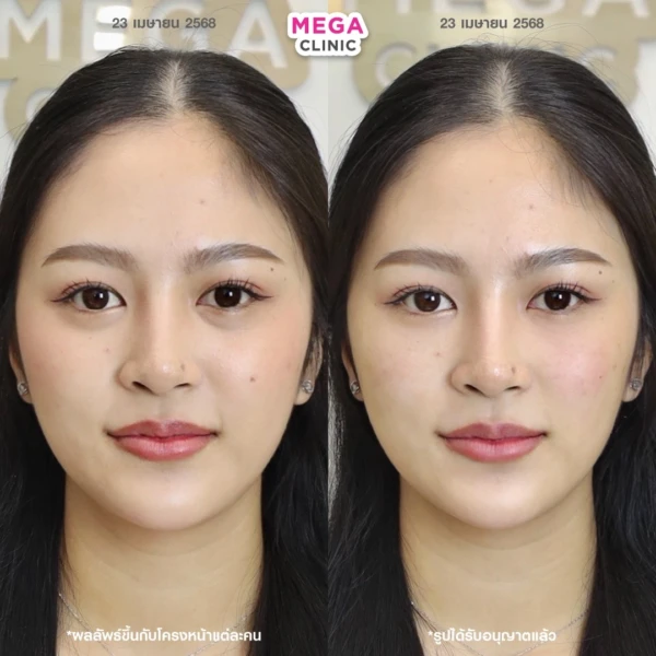 眼底填充剂评论