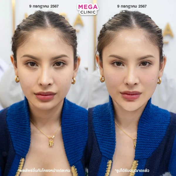 眼底填充剂评论