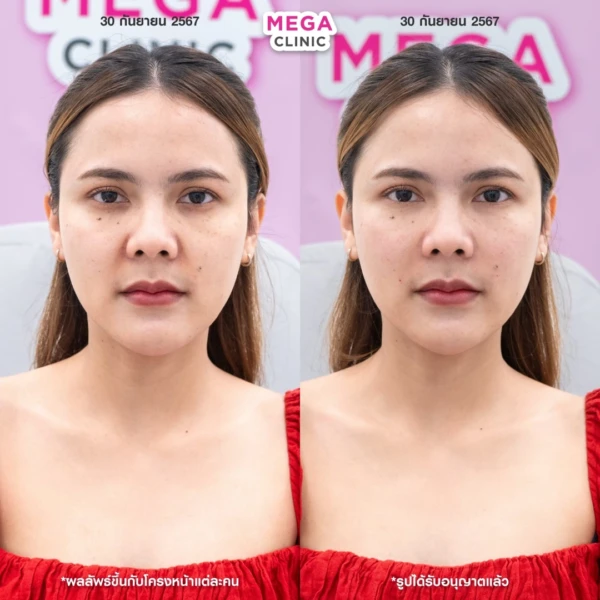 眼底填充剂评论