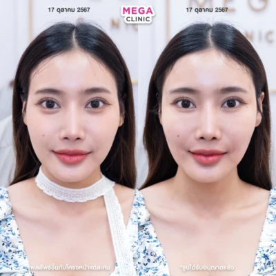 รีวิว ฟิลเลอร์ใต้ตา