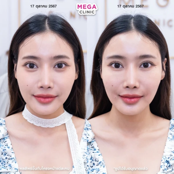 眼底填充剂评论