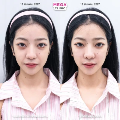 รีวิว ฟิลเลอร์ใต้ตา