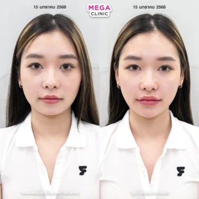 รีวิว ฟิลเลอร์ใต้ตา