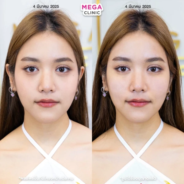 眼底填充剂评论