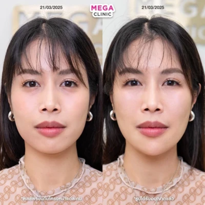 รีวิว ฟิลเลอร์ใต้ตา