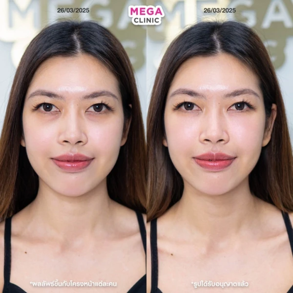 眼底填充剂评论