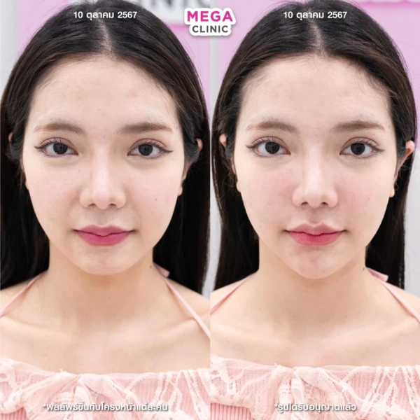 รีวิว ฟิลเลอร์คาง