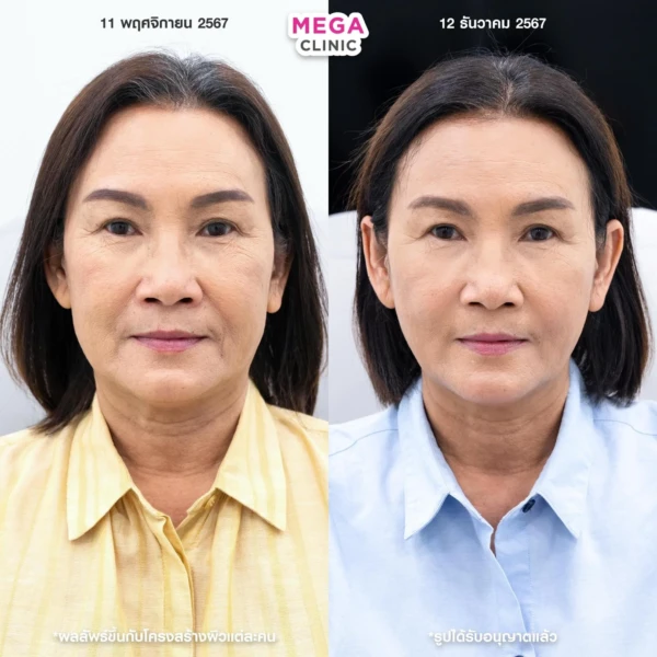 ฉีด sculptra รีวิว