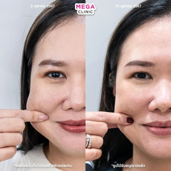 ฉีด sculptra รีวิว
