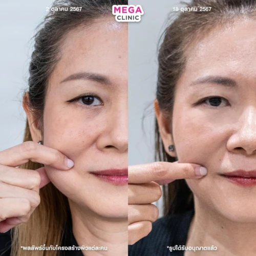 ฉีด sculptra รีวิว