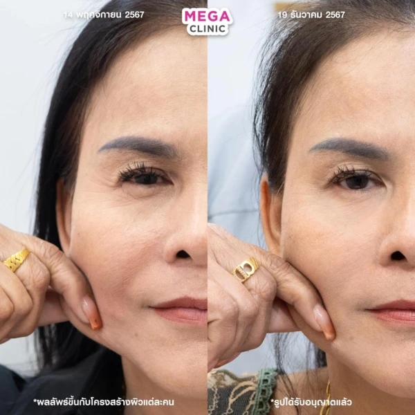 ฉีด sculptra รีวิว
