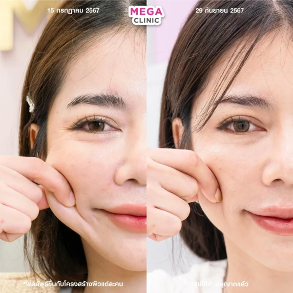 ฉีด sculptra รีวิว