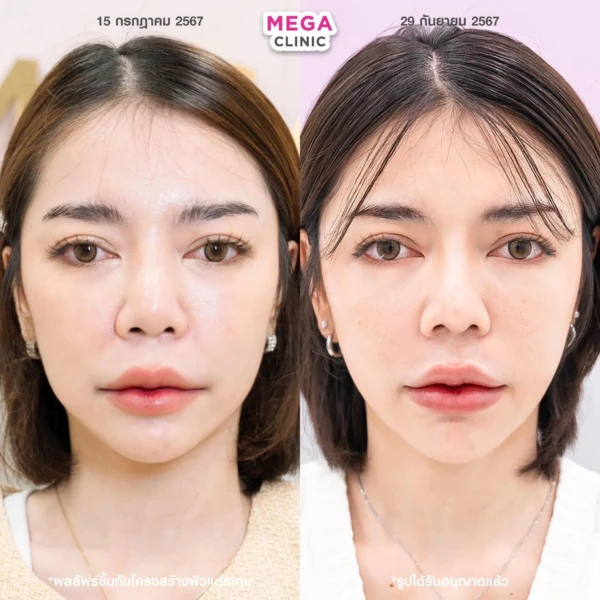 ฉีด sculptra รีวิว