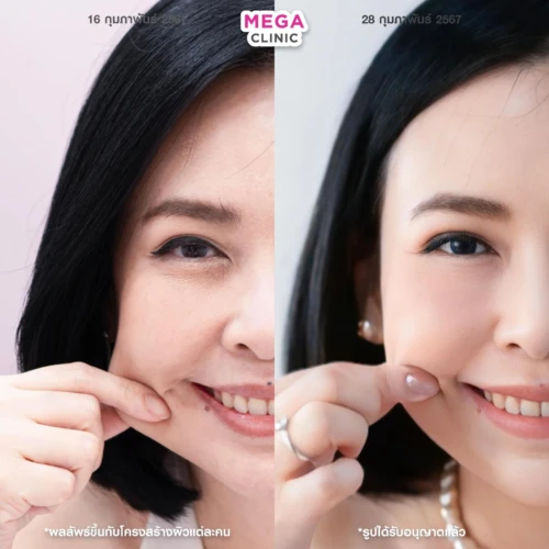 ฉีด sculptra รีวิว