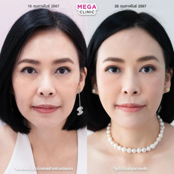 ฉีด sculptra รีวิว