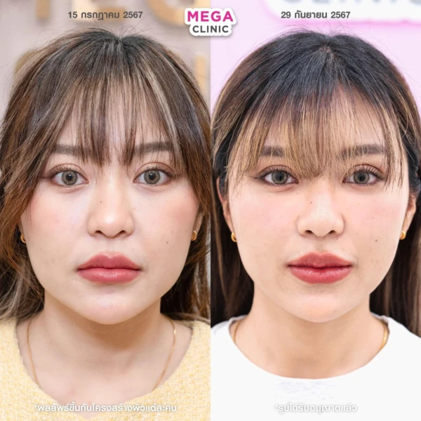 ฉีด sculptra รีวิว