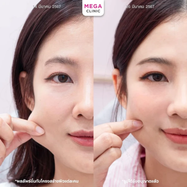 ฉีด sculptra รีวิว
