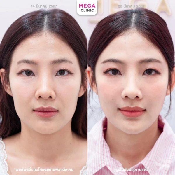 ฉีด sculptra รีวิว