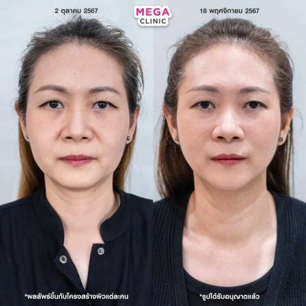 ฉีด sculptra รีวิว
