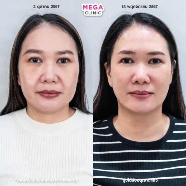 ฉีด sculptra รีวิว