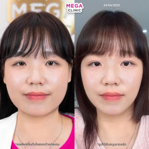 รีวิว ก่อน–หลัง ฉีดแฟตแก้ม ฉีดแฟตเหนียง