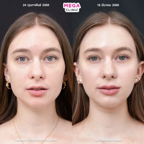 โบท็อกกราม ช่วยหน้าเรียว