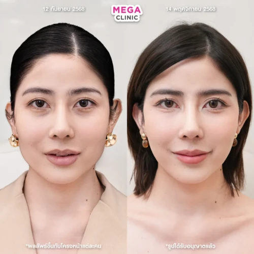 โบท็อกกราม ช่วยหน้าเรียว