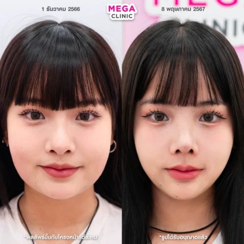 รีวิว โบท็อกกรามคู่กับแฟตสลายไขมัน