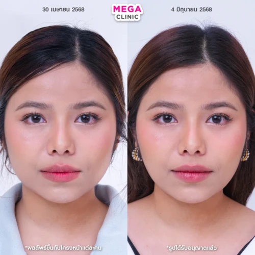 รีวิว โบท็อกกราม