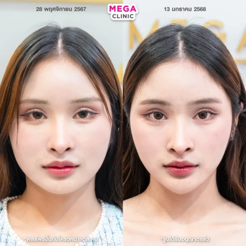 รีวิว โบท็อกกราม