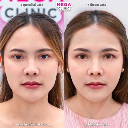 รีวิว โบท็อกกราม